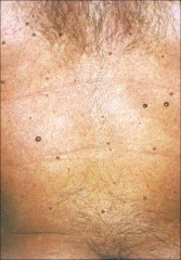 Cherry Angioma:
-Common
-asymptomatic
-bright red domed papules
- on trunk
increase number over years
Treatment: electrocautery or laser
benign
