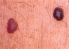 Cherry Angioma:
-Common
-asymptomatic
-bright red domed papules
- on trunk
increase number over years
Treatment: electrocautery or laser
benign