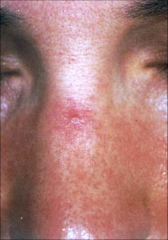 Spider Angioma:
-Red
-focal telangiectatic network of dilated capillaries radiating form a central arteriole
-face, forearms, hands
-female more than males
-associated with hyperestrogen states and liver disease
Treatment: laser, electrocautery