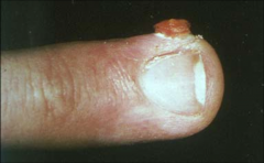 Pyogenic Granuloma:
- bright red to violaceous smooth dome shaped nodule 
-bleeds frequently
-fingers, lips, mouth, trunk, toes
Treatment- surgical excision