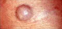 Epidermoid Cysts:
- most common cutaneous cyst
-formed by cystic closure of epithelial cells in the dermis usually in the hair follicle
-young middle aged adults
-face neck upper trunk scrotum
-solitary dermal or subcutaneous middle filled with foul 