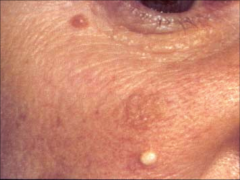 Milium:
-1-2 mm 
-superficial white to yellow
-keratin containing epidermal cyst
-located on eyelids cheek forehead and site of trauma
-occur at any age
- Treatment: Incision and expression of contents