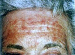 Actinic Keratosis: Sun Damaged 
-common
-Sun induced
-premalignant lesions
- Single or multiple discrete rough adherent scaly papules
- Arise in areas of head neck hands
- Premalignant potential, may develop into SCC, cutaneous horn
Treatment: Cryo