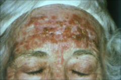 Actinic Keratosis:
-common
-Sun induced
-premalignant lesions
- Single or multiple discrete rough adherent scaly papules
- Arise in areas of head neck hands
- Premalignant potential, may develop into SCC, cutaneous horn
Treatment: Cryotherapy