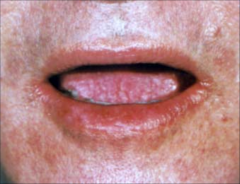 Actinic Keratosis:Around mouth very sensitive 
-common
-Sun induced
-premalignant lesions
- Single or multiple discrete rough adherent scaly papules
- Arise in areas of head neck hands
- Premalignant potential, may develop into SCC, cutaneous horn
