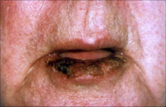 Actinic Keratosis:Too late very damaged; Oral cancer 
-common
-Sun induced
-premalignant lesions
- Single or multiple discrete rough adherent scaly papules
- Arise in areas of head neck hands
- Premalignant potential, may develop into SCC, cutaneous