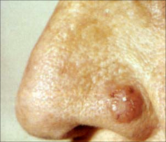 Basal Cell Carcinoma: Nodular - pearly papule or nodue with telangiectasia, rolled border
-Most common type of skin cancer
-locally invasive and aggressive
-limited capacity to metastasize
-occur over 40 males more than females
-poor tanning and albi