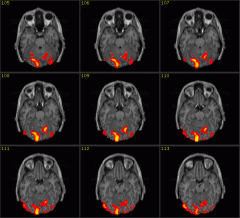 What is a functional magnetic resonance imaging (fMRI)?