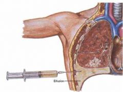 usually done in the 7th or 8th ICS MAL (for fluids or fluids and air) or at the 2nd ICS MCL (for air alone) 


needle is inserted in an intercostal space close to the upper border of the rib below to avoid injury to the neurovascular bundle