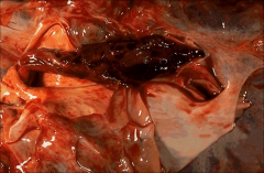 A large embolism that straddles the arterial bifurcation and thus blocks both branches.