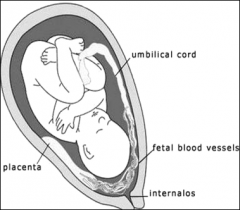 a placenta in which the umbilical  blood vessels abnormally travel through the amniochorionic membrane before reaching the placenta proper.