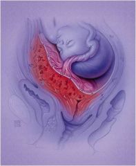 an abnormally deep 
attachment of the 
placenta, through the 
endometrium and into 
the myometrium.