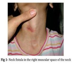 Abnormal canal that opens internally into the tonsillar sinus and externally in the side of the neck


Results from persistence of parts of =