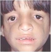 *Mandibulofacial dysostosis, caused by an =

*malar hypoplasia (underdevelopment of the 

also:
Downslanting palpebral fissures
Defects of the lower eyelids
Deformed external ears
abnormalities of the middle and internal ears