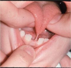 frenulum is short and extends to the tip of the tongue . This interferes with its free protrusion and may make breast-feeding difficult.