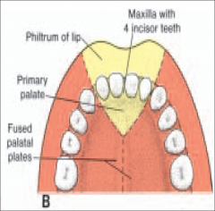 MD1 Embryology Block 3 Pharangeal Arches Part D Palate Flashcards ...