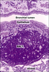 Bronchus Associated Lymphoid Tissue (BALT)