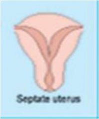 Septate uterus:
 occur when the medial 
walls of the caudal portion 
of the =