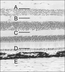 Which label in the Figure indicates the typical
plane of separation at which retinal detachment
occurs?

A. 

B.

C.

D.

E.