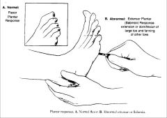 Extension of the big toe and fanning the lateral sign in response to plantar reflex (when plantar aspect of the foot is stimulated by non-nonciceptive stimuli).  Sign of an upper motor neuron injury** most common pathologic sign of UMN injury.
