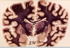 in this picture, 1=thalmus.  What is the white matter just adjacent to it?