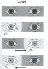 looking at the responses in each pupil as you swing light between the eyes.  Should see sustained pupillary constriction throughout.  an abnormal response would show paradoxical response (dilation)
