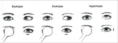 Test for evaluating tropia. Cover the fixating eye and observe the response in the non fixating eye.