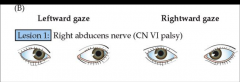 Leftward gaze would appear normal.  On attempting rightward gaze, the right eye would only shift to the middlle-ish, not all the way over to the right