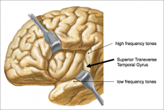 aka Heschl's gyrus.  receives primary  auditory input from the medial geniculate.  This is Brodmann's area 41.