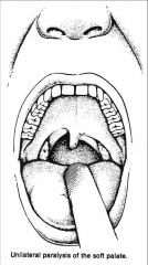 Have pt open mouth and say "ahhh".  Uvula deviates to the R.  What is the issue??