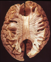 between lobes in each hemisphere (so like occipital to occipital or frontal to frontal).  Note that it connects AREAS not specific gyri or specific targets