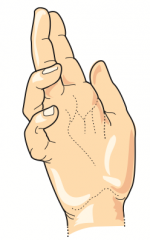 "Ulnar Claw" sign: occurs when extending fingers / at rest