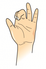 "Median Claw" sign: occurs when extending fingers / at rest