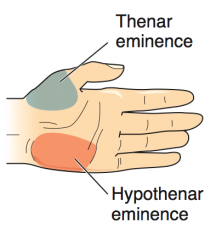 What causes atrophy of the thenar eminence (unopposable thumb)?
