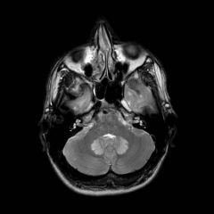 MRI of a 6 yO boy presented with GTC sz. one during febrile illness and the 2nd w/o, known mild LD (FSIQ=78). 
describe?
suggested diagnosis?