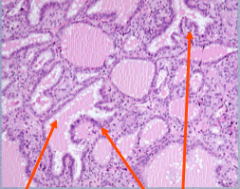 Identify what the arrows are points to.
 
The thyroid epithelium in Graves disease is _______ (too many cells present)
 
What is term used to describe the colloid?