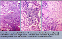 Early: lymphocytic infiltration
Late: fibrosis (right panel) 
Disruption of thyroid follicles with subsequent release of thyroid hormones (hashitoxicosis)