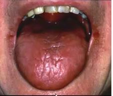 hows shingles diagnosed and managed? whats the prognosis? whats the condition called that gives persistant facial nerve weakness?
