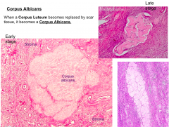 Corpus Albicans - the replacement of the corpus luteum by scar tissue