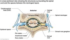 epidural space is outside the dura. i.e. if you go to far its a "dural tap"
Borders: ant=verterbral body/post longitudinal ligament
Post= ligamentum flavum/verterbral arch. 
NOTE - the dura IS NOT the anterior border of the epidural space as the e...