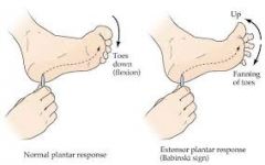 it is an upper motor neuron damage
the big toe goes up when the the sole is stimulated