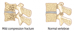 Vertebral crush fractures:
- Acute back pain
- Loss of height
- Kyphosis