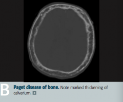 Paget Disease of Bone (Osteitis Deformans)
- Marked thickening of calvarium
