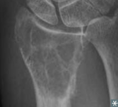 What type of bone tumor should you expect in a young patient, if present in the epiphyseal end of long bones, with a "soap bubble" appearance on x-ray? Characteristics?