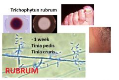 CLINICAL SYMPTOMS:
- circular erythematous scaling border
- soft wrinkled skin
- brittle and discoloured nails
- Tinea pedis, Tinea cruris
- normally sees growth in 1 week
