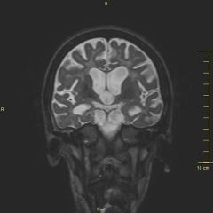 10 yO boy, MR+ ataxia+severe cachexia
describe the MRI
diagnosis? 
