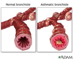 Inflammation i bronkerna
Immunceller reagerar när kroppen kommer i kontakt med allergena ämnen.
Leder till luftobstruktion.
Behandlas med medicin och lätt träning