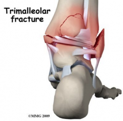Fracture of the ankle that involves the lateral malleolus, the medial malleolus, and the distal posterior aspect of the tibia
