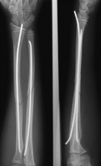 Elastic intra-medullary nails