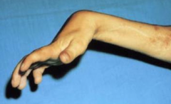 Volkmann's ischaemia
Permanent flexion contracture of the hand at the wrist due to ischaemia and fibrosis of the flexor muscles of the forearm. 